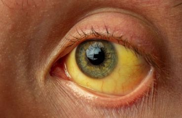 Gelbe Augen – Ursachen und Behandlung