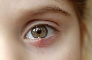 Gerstenkorn im Auge: Ursachen, Behandlung & Dauer