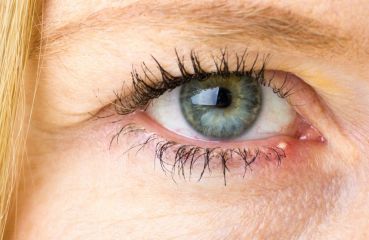 Hagelkorn am Auge: Diagnose und Behandlung