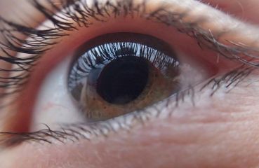 Leiden Sie unter einem faulen Auge? Amblyopie kann Ihr Sehvermögen erheblich verschlechtern