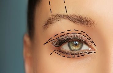 Schlupflider ohne klassisches Skalpell: Warum die Laser-Blepharoplastik eine schonendere Alternative sein kann
